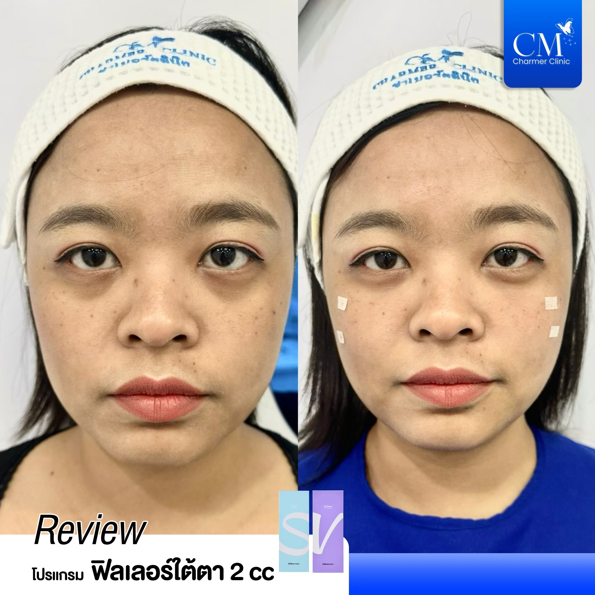 review รีวิว HYAFILIA