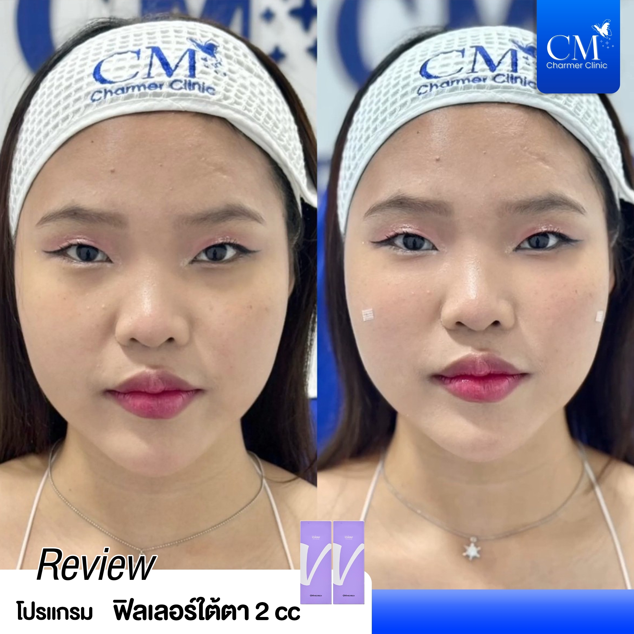review รีวิว HYAFILIA