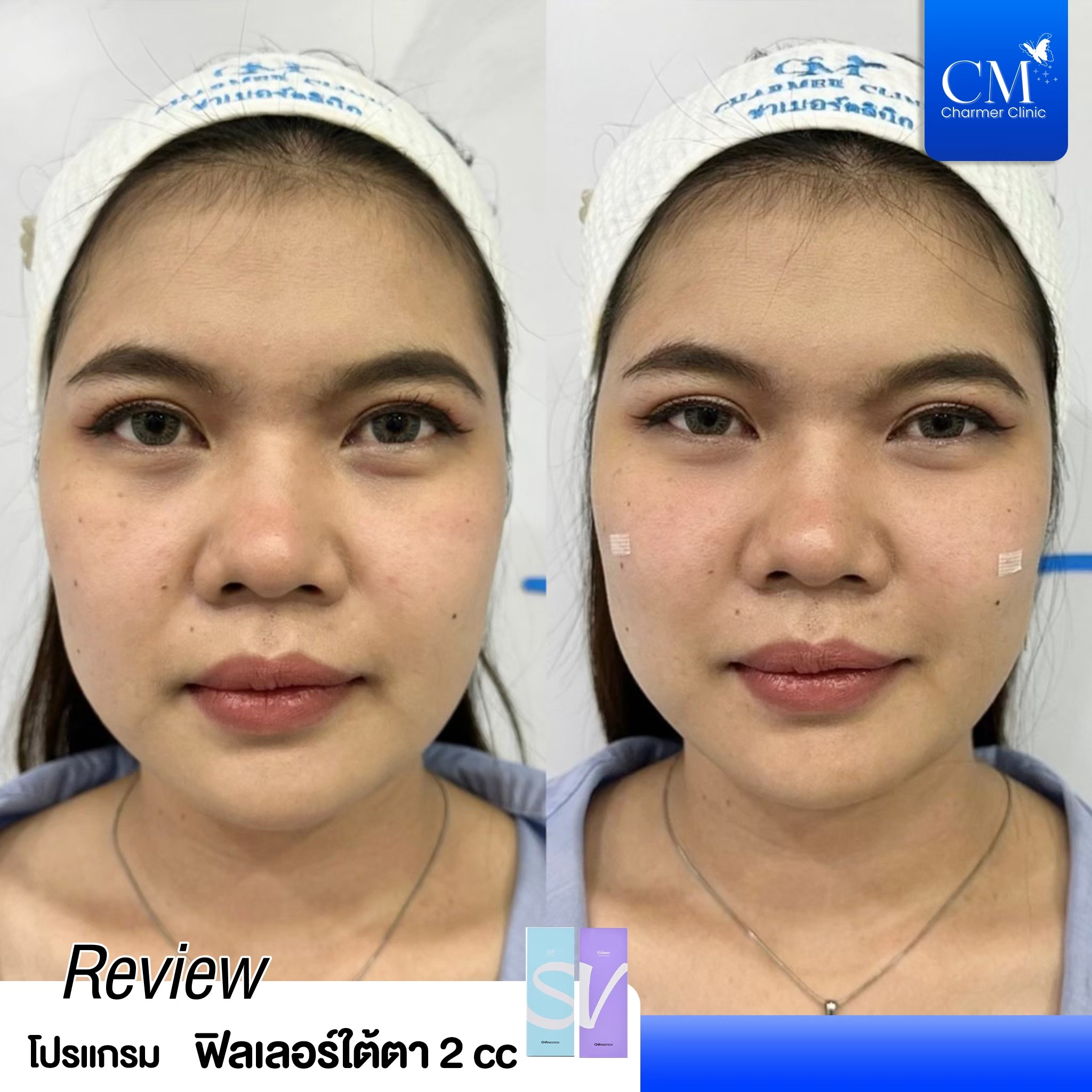 review รีวิว HYAFILIA