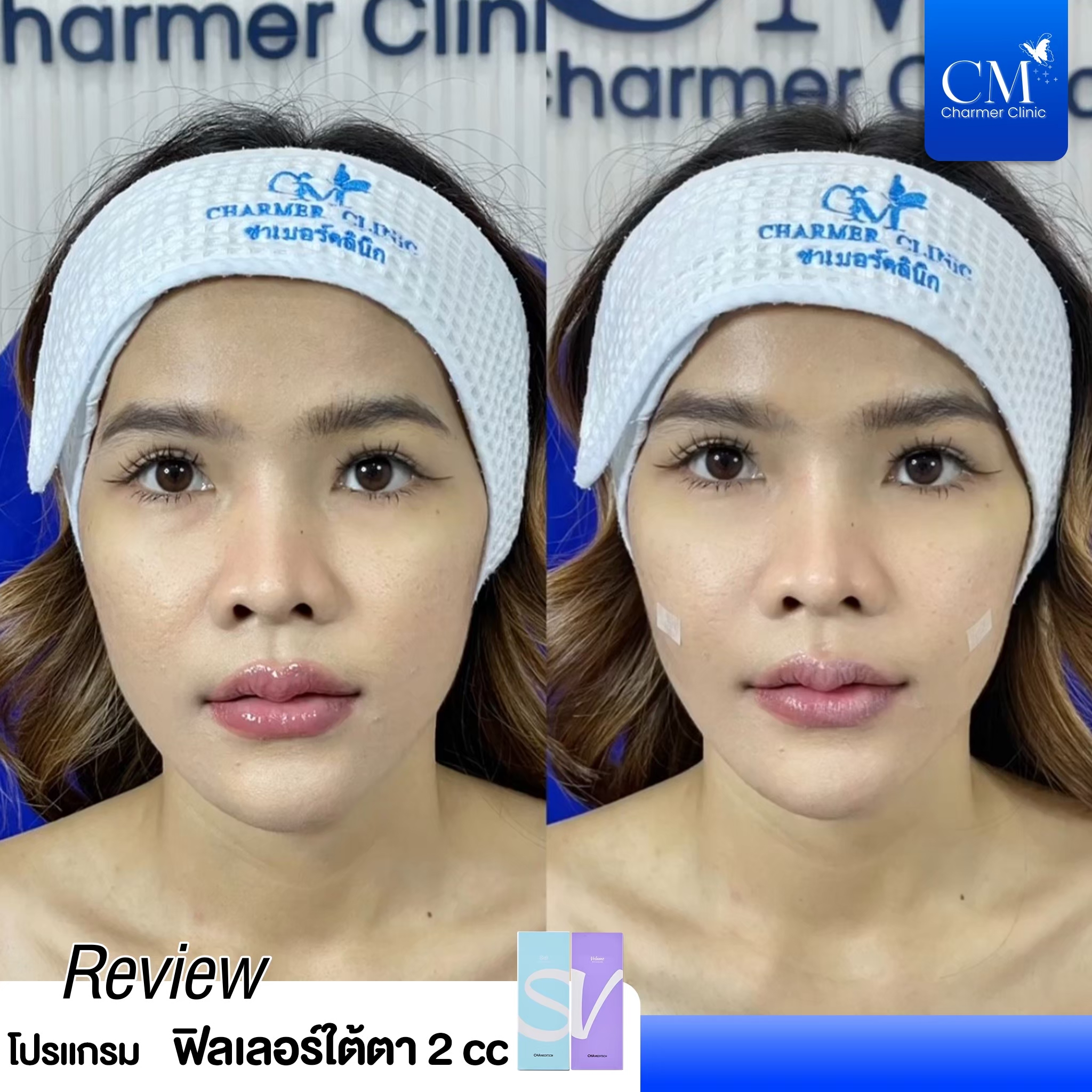 review รีวิว HYAFILIA