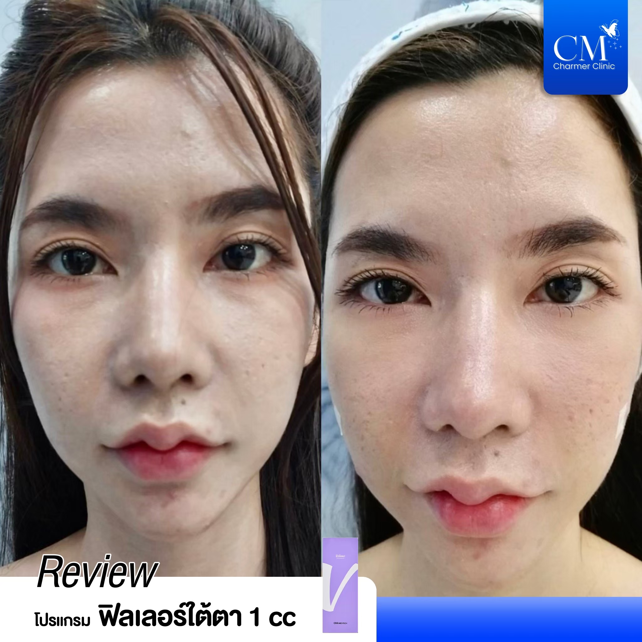 review รีวิว HYAFILIA