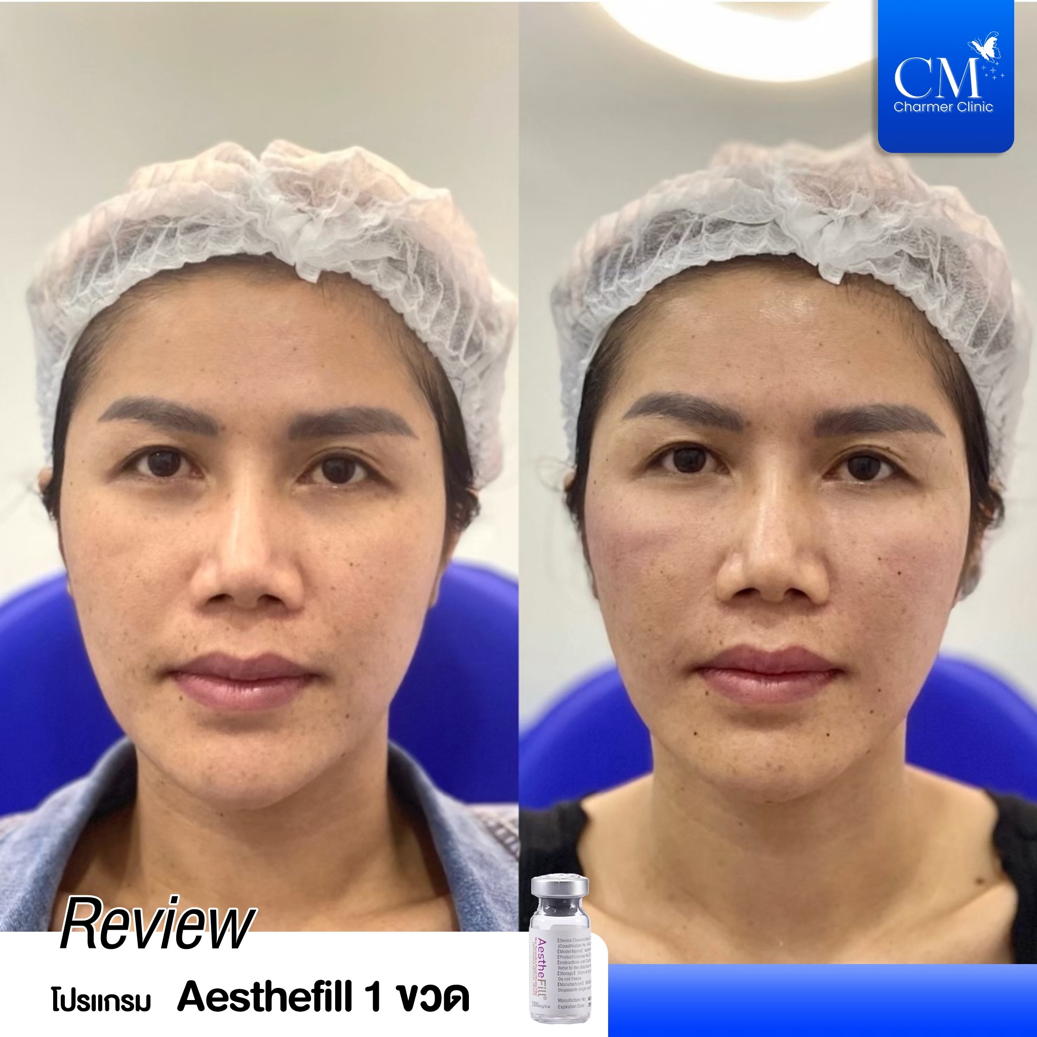 Review Aesthefill