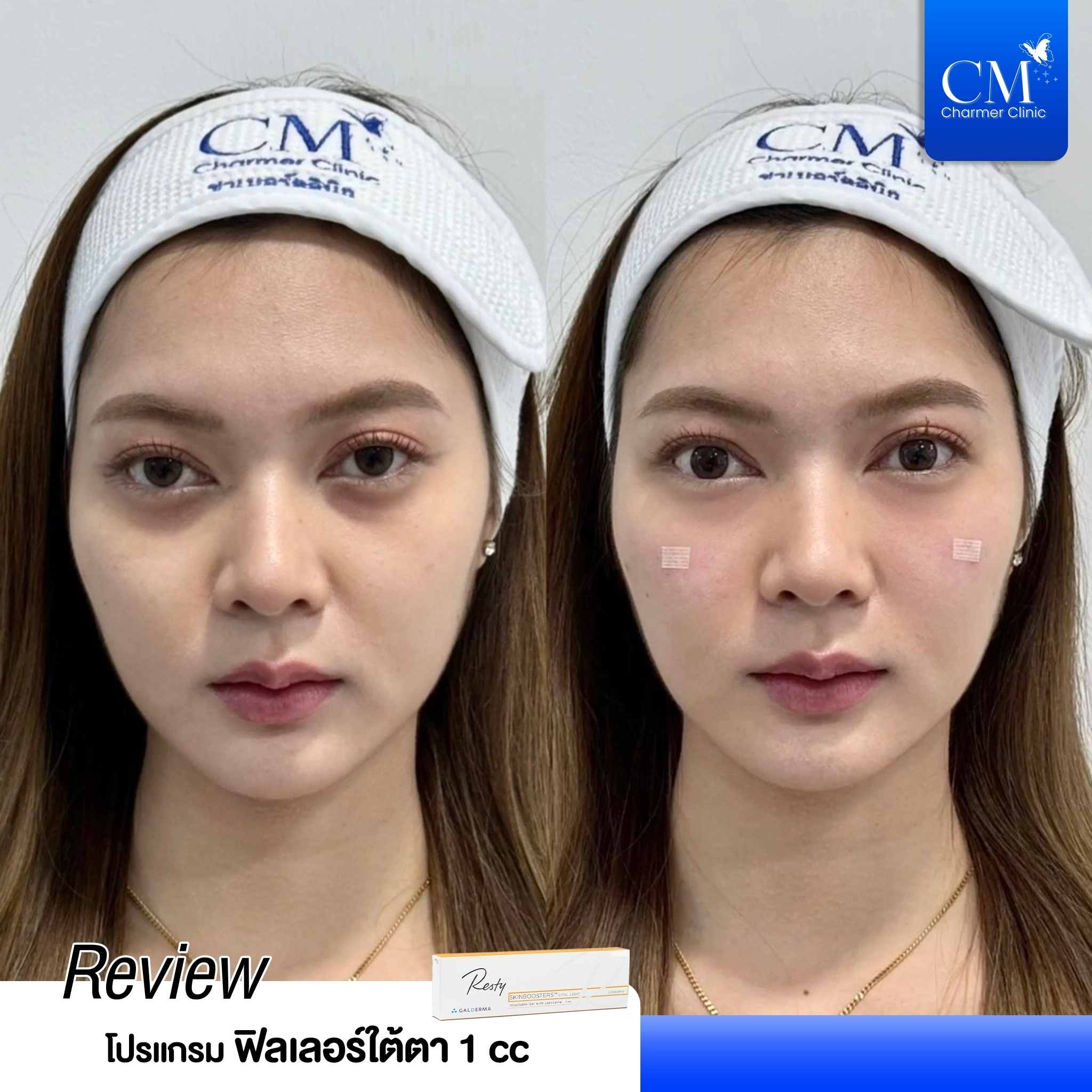 review รีวิว ฟิลเลอร์ (Filler)