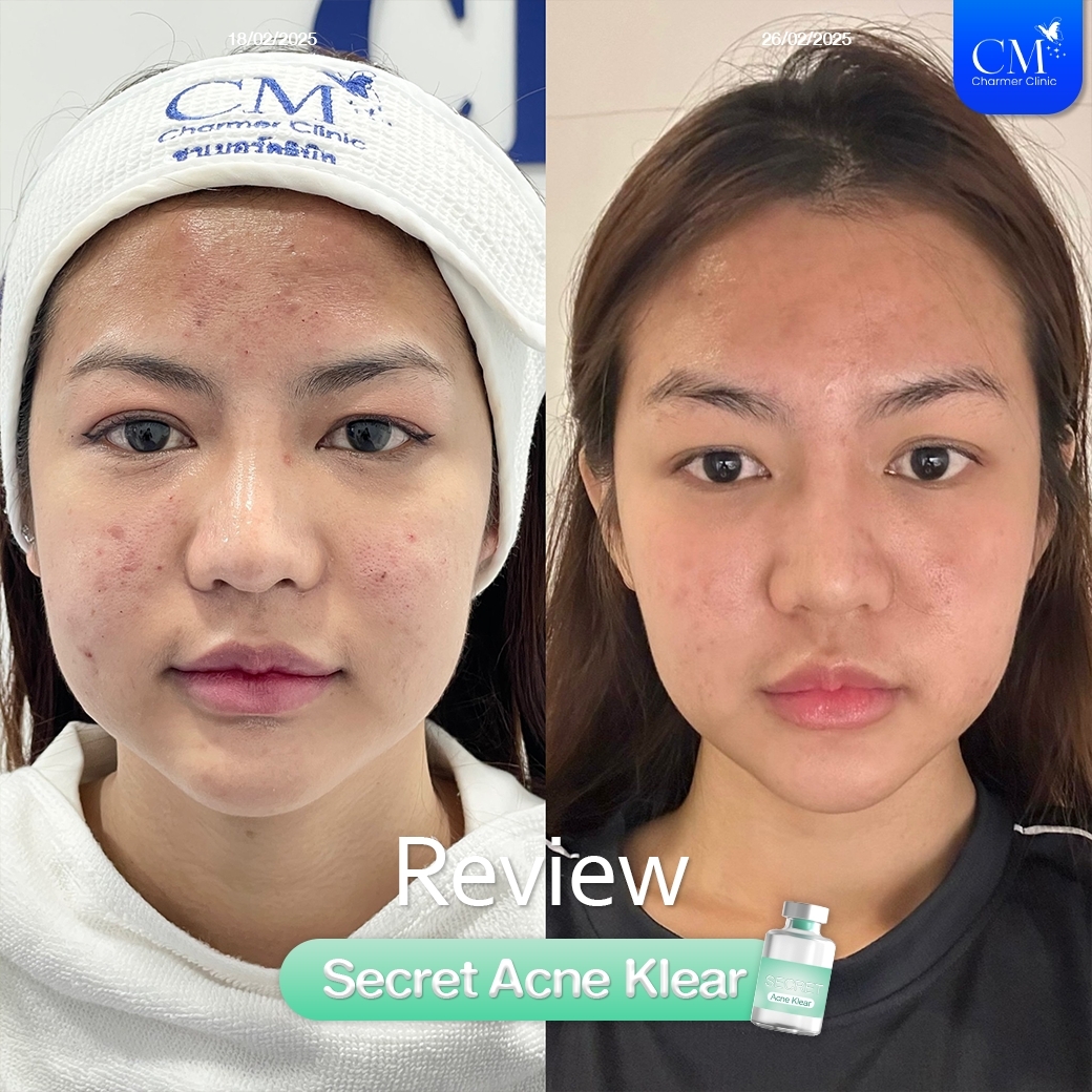 Review Secret Acne Klear